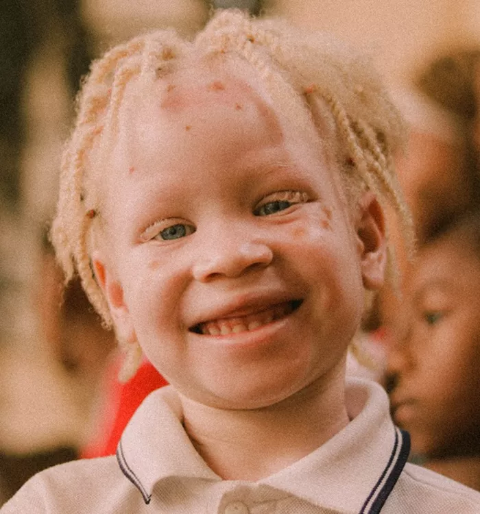 Child with albinism.